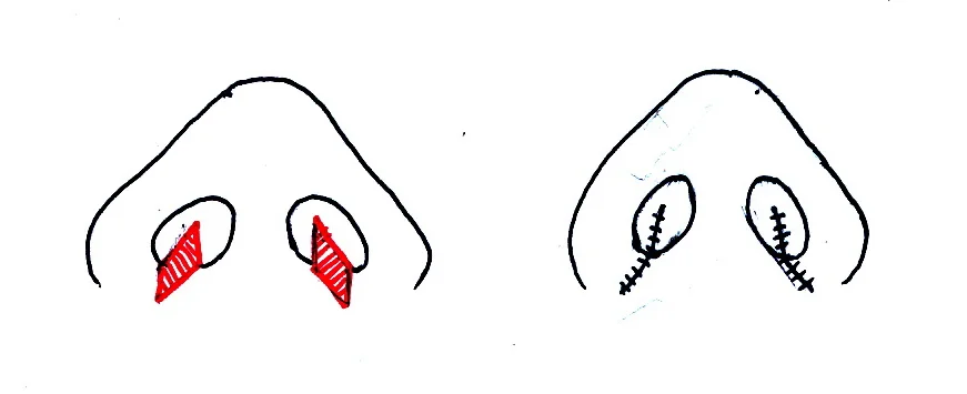 小鼻縮小手術の解説図