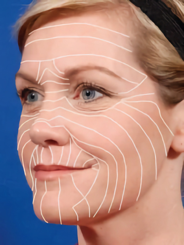 顔の皮膚緊張線（ストレスライン）