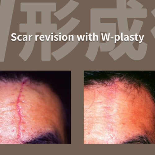 醜いキズあとを消す特別な方法～W形成術 - 美容外科・美容皮膚科