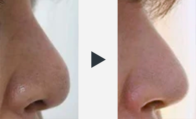 鼻整形の修正手術・サイドからみた症例写真