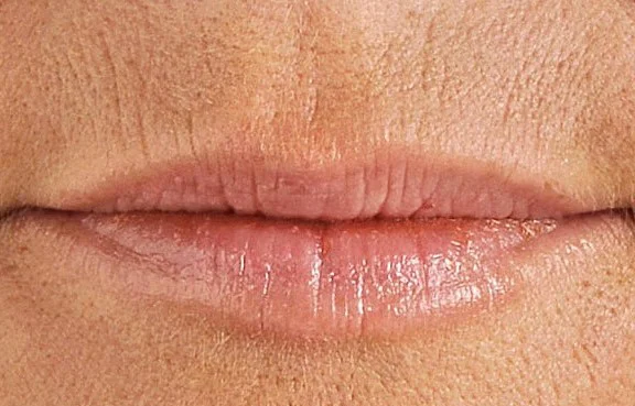 老化した唇の典型例