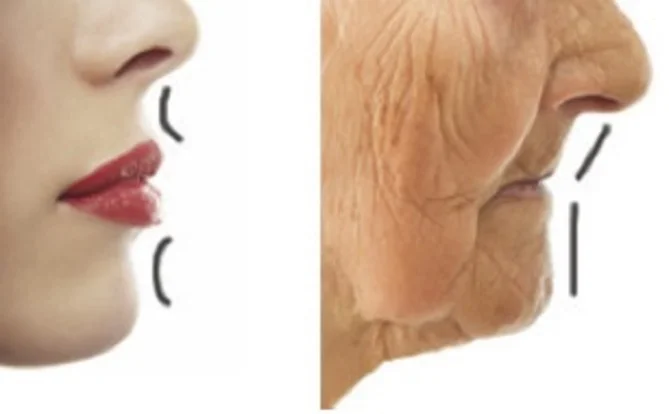 唇が加齢とともにふっくら感が無くなり横から見ると逆に凹んだような状態になる