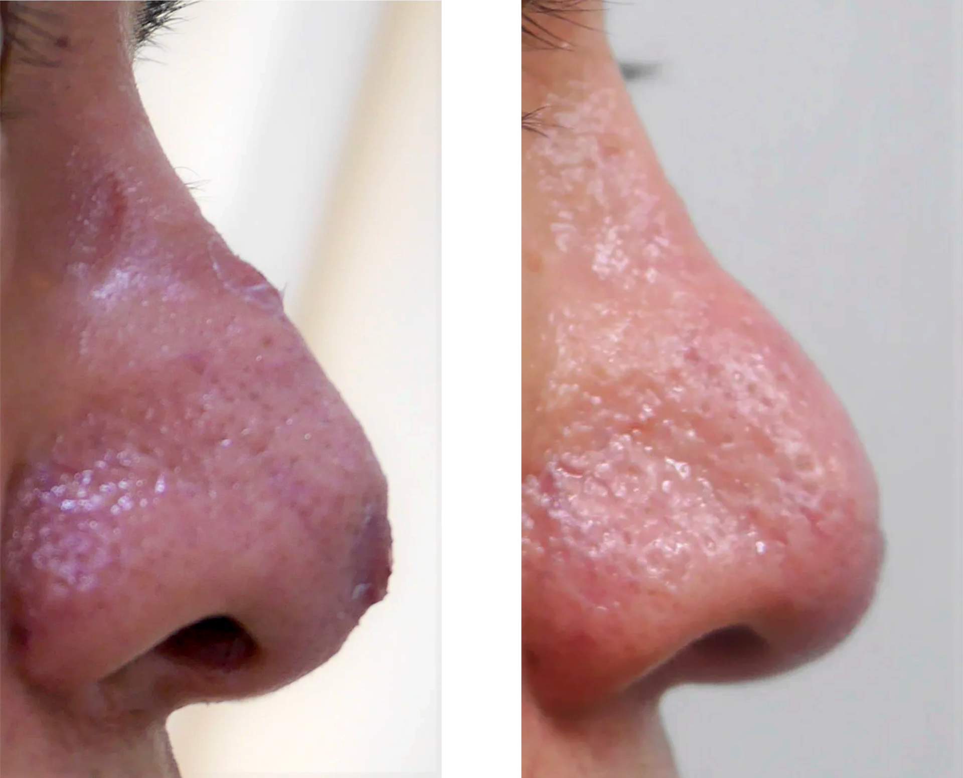 鼻プロテーゼで鼻の皮膚に穴が開いてしまった男性の治療の前後の比較写真
