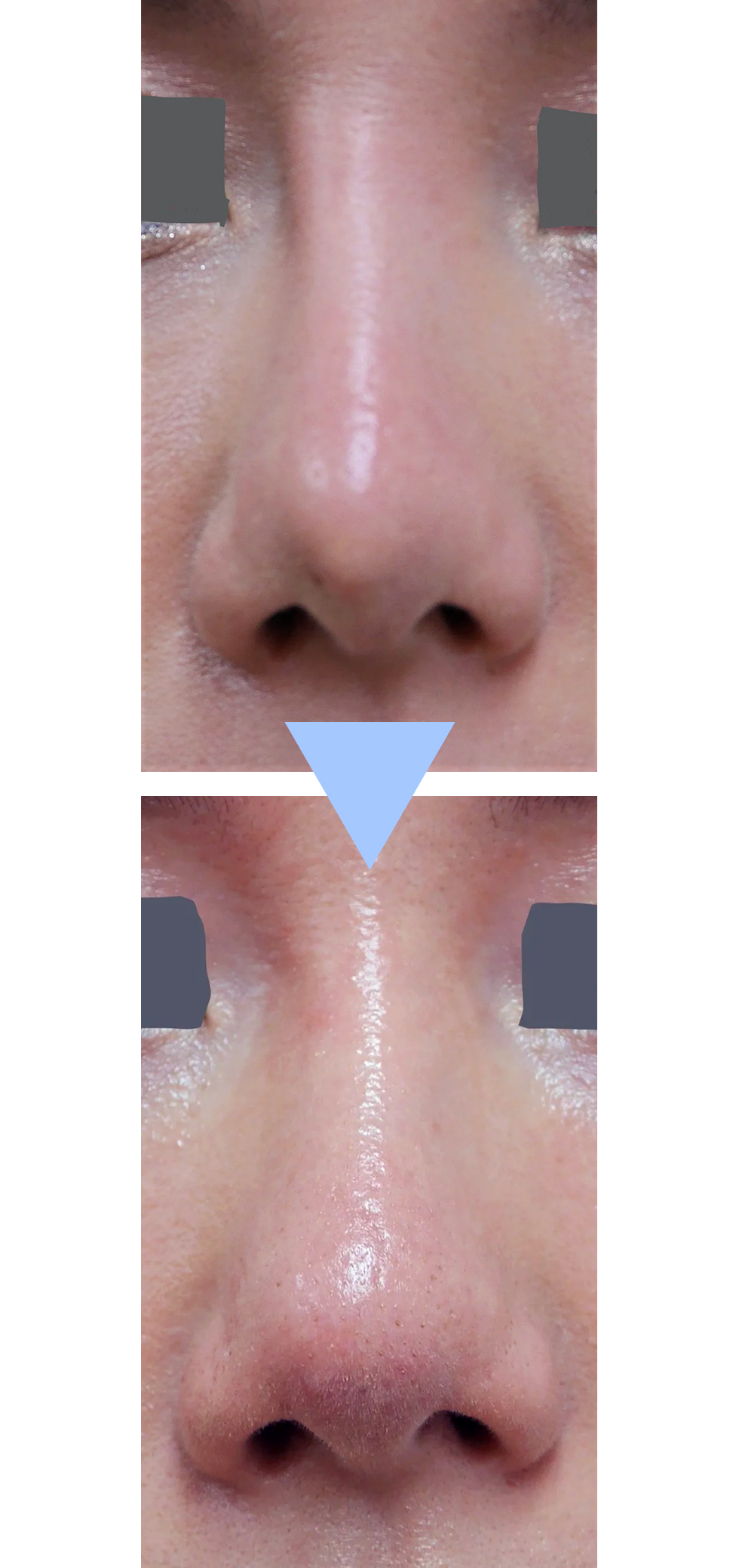 鼻に入れたプロテーゼを抜いて自家組織移植したビフォーアフター写真(正面)