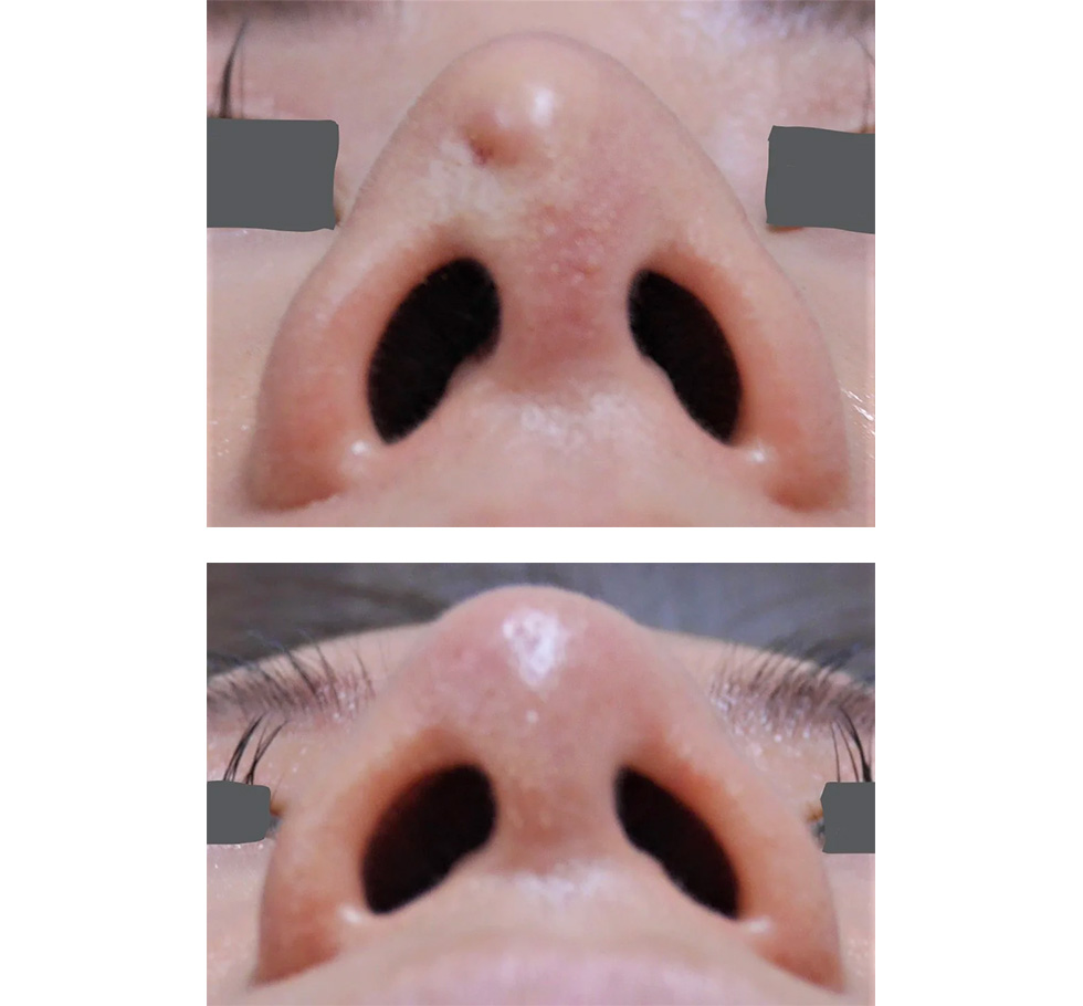 鼻に入れたプロテーゼを抜いて自家組織移植したビフォーアフター写真(下から撮影)