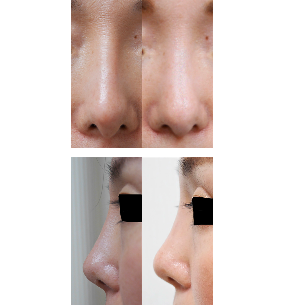鼻の他院修正手術の術前と術後8ヶ月の比較写真（執刀医：松下洋二）
