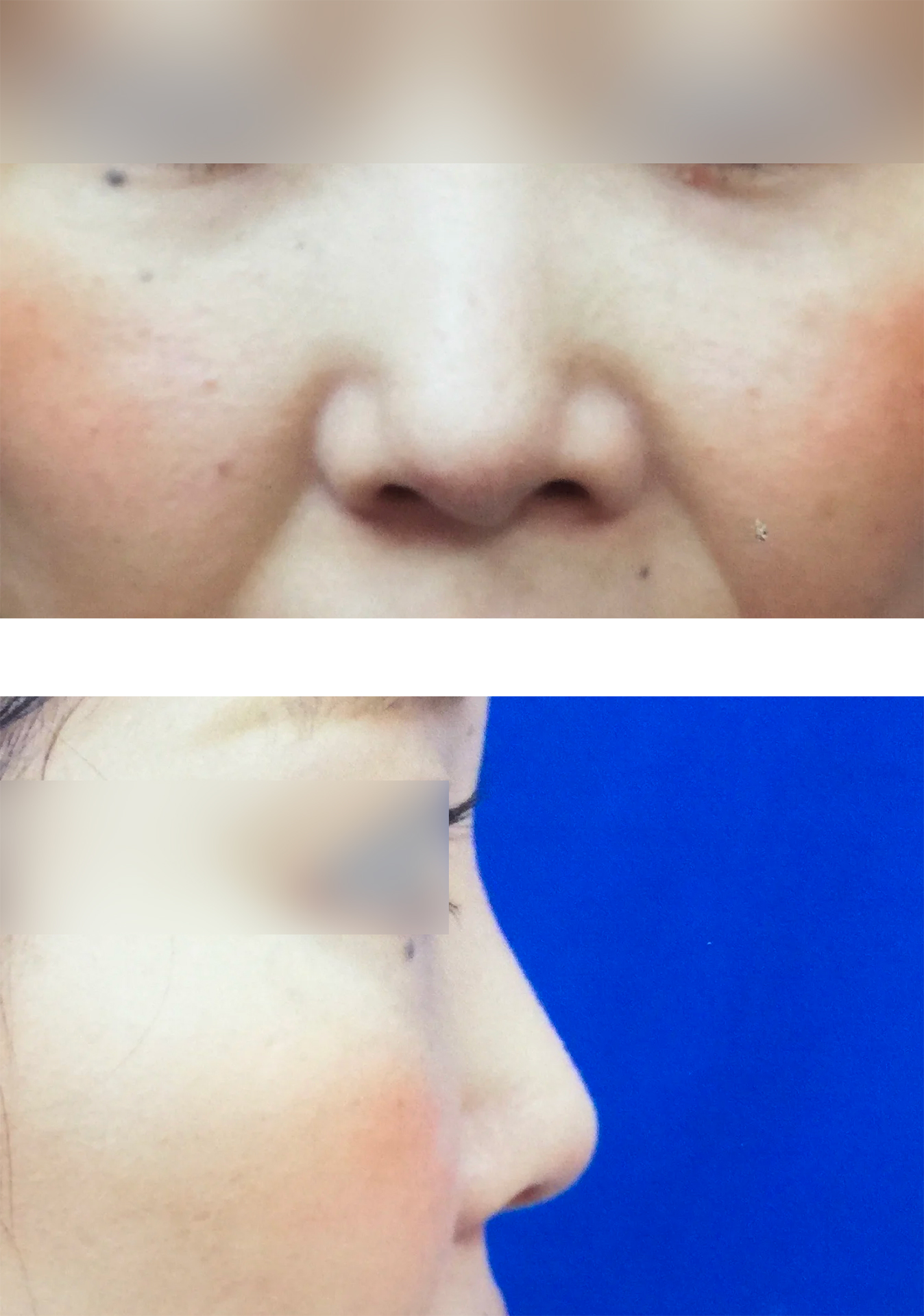 鼻の他院修正の手術の術後半年の写真