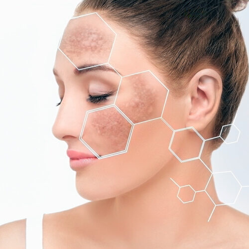 シミの原因・治療・予防の全て - 美容外科・美容皮膚科｜五本木クリニック