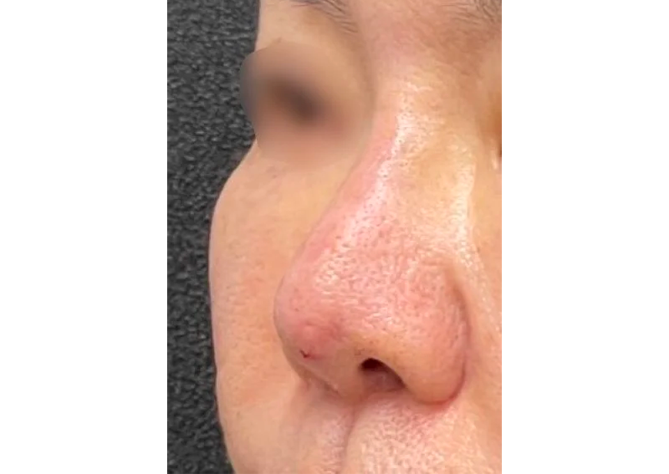 鼻先の手術跡を目立たせないようにするテクニック