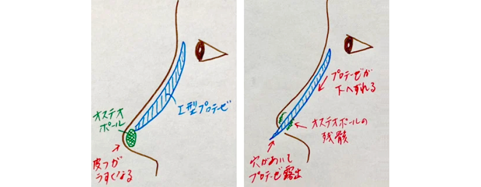I型プロテーゼとオステオポオールによる鼻整形でトラブルが起こった理由の解説図