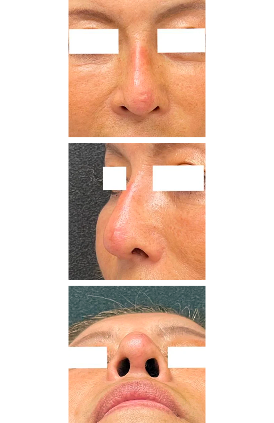 鼻からプロテーゼとオステオポールを除去する手術後の写真