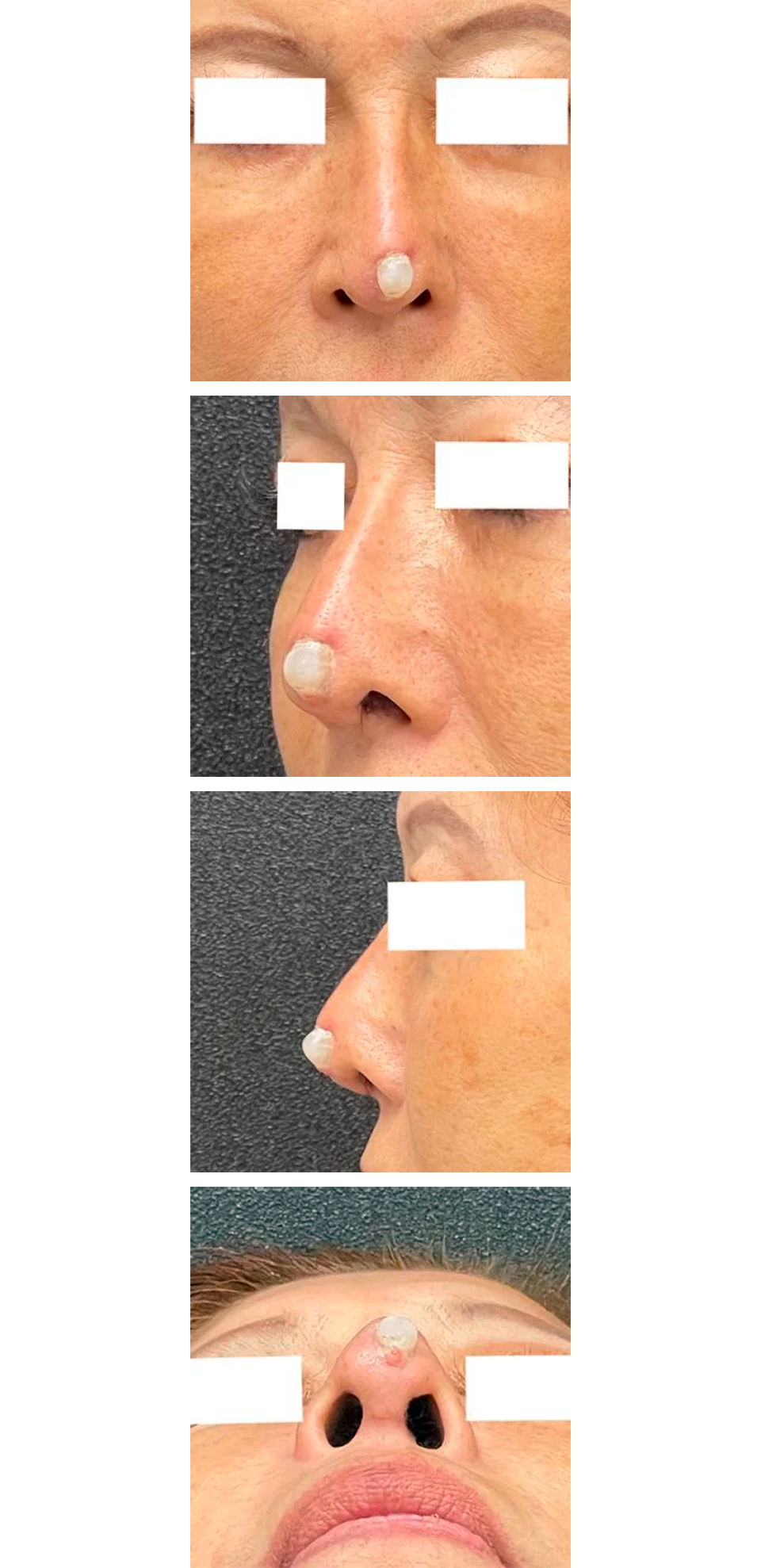 鼻に入れたプロテーゼとオステオポールを除去する手術前の写真