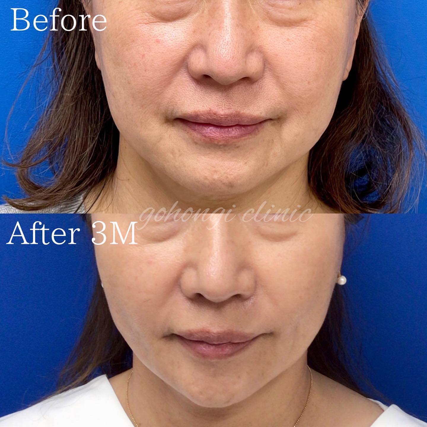 顔の脂肪吸引とVOVリフト同時施術の症例写真(60代女性)