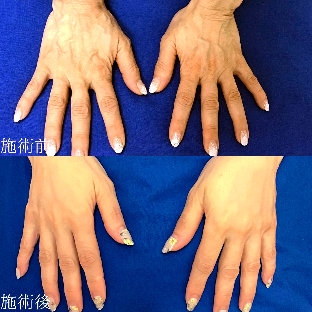 手の甲の皺をヒアルロン酸注入で改善した症例