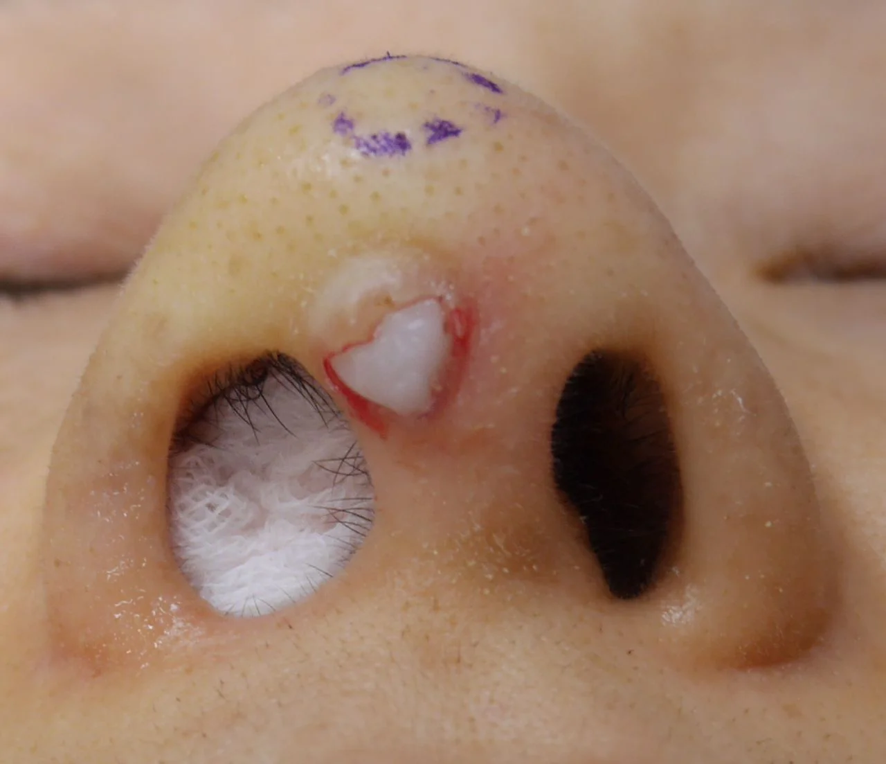 プロテーゼが原因で鼻先の皮膚に開いてしまった穴を塞ぐ治療の様子