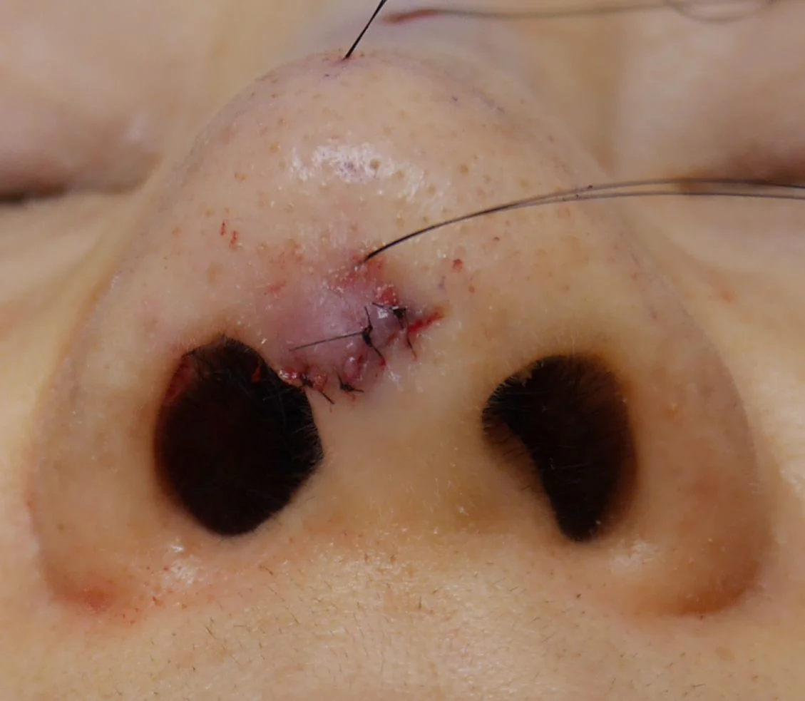 プロテーゼが原因で鼻先の皮膚に開いてしまった穴を塞ぐ治療の治療直後の様子