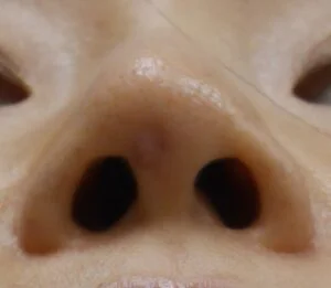 プロテーゼが原因で鼻先の皮膚に開いてしまった穴を塞ぐ治療の治療後3ヶ月のの様子