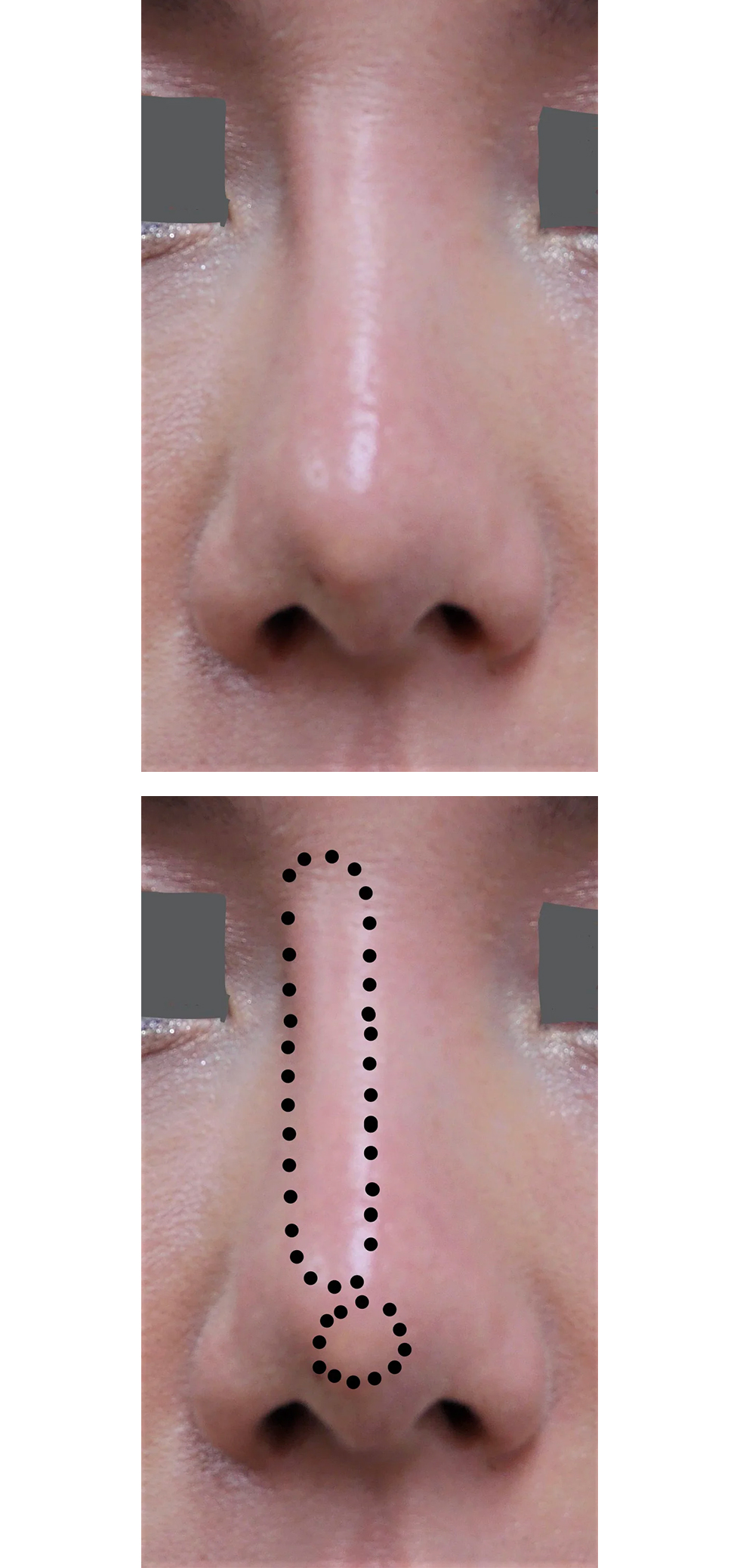 鼻に入れたプロテーゼの輪郭が浮き出て来てしまった症例写真