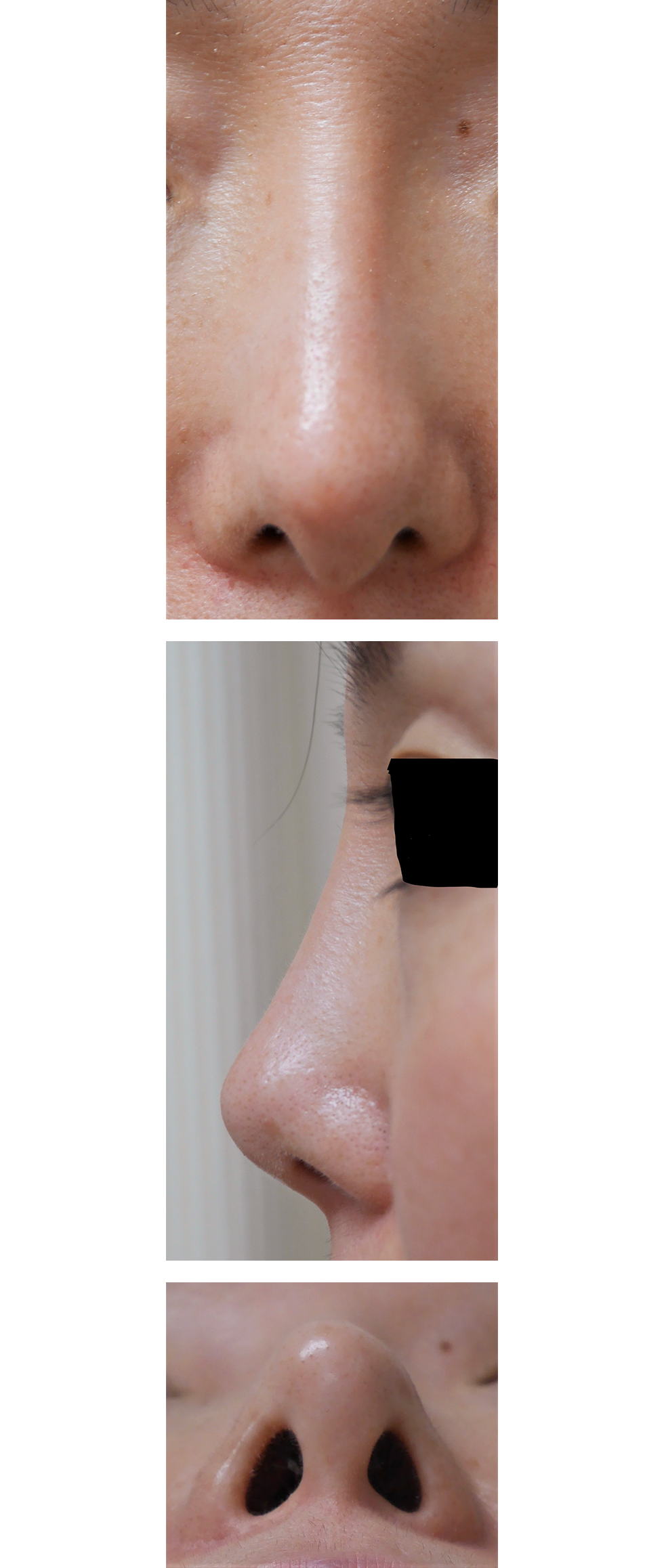 鼻プロテーゼ抜去＆自家組織移植手術前の鼻の写真