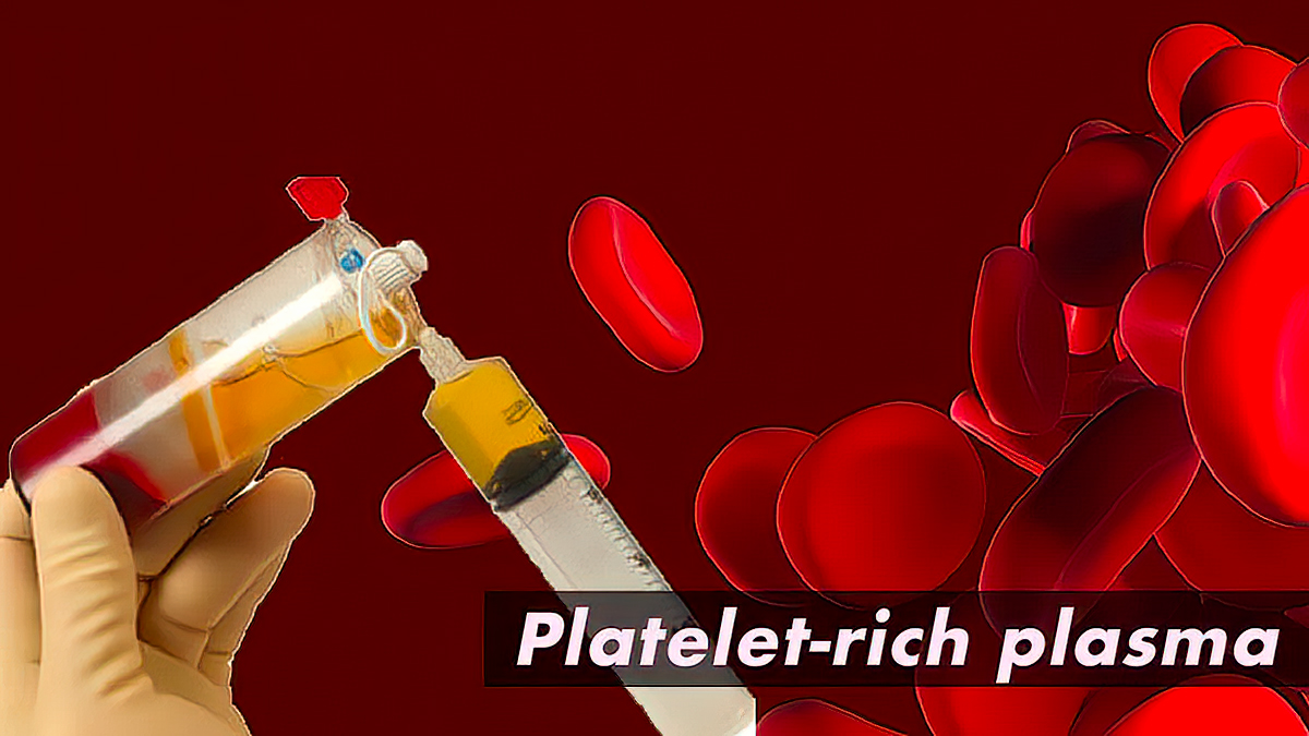 五本木クリニックではPlatelet-rich plasma(PRP)療法を行っています